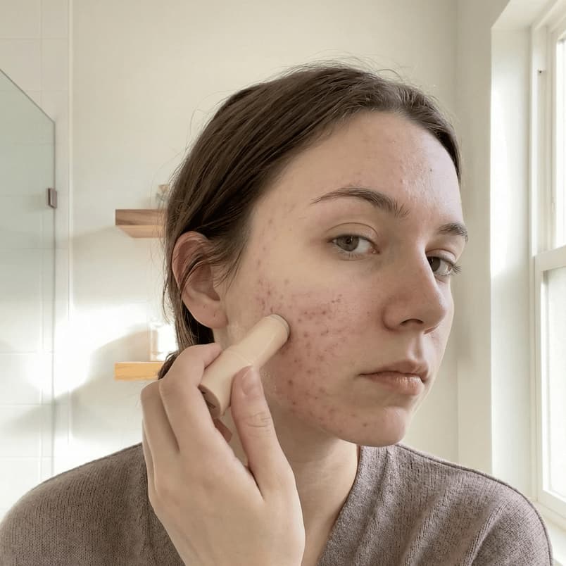 Woman applying Pluune scar stick to acne scars