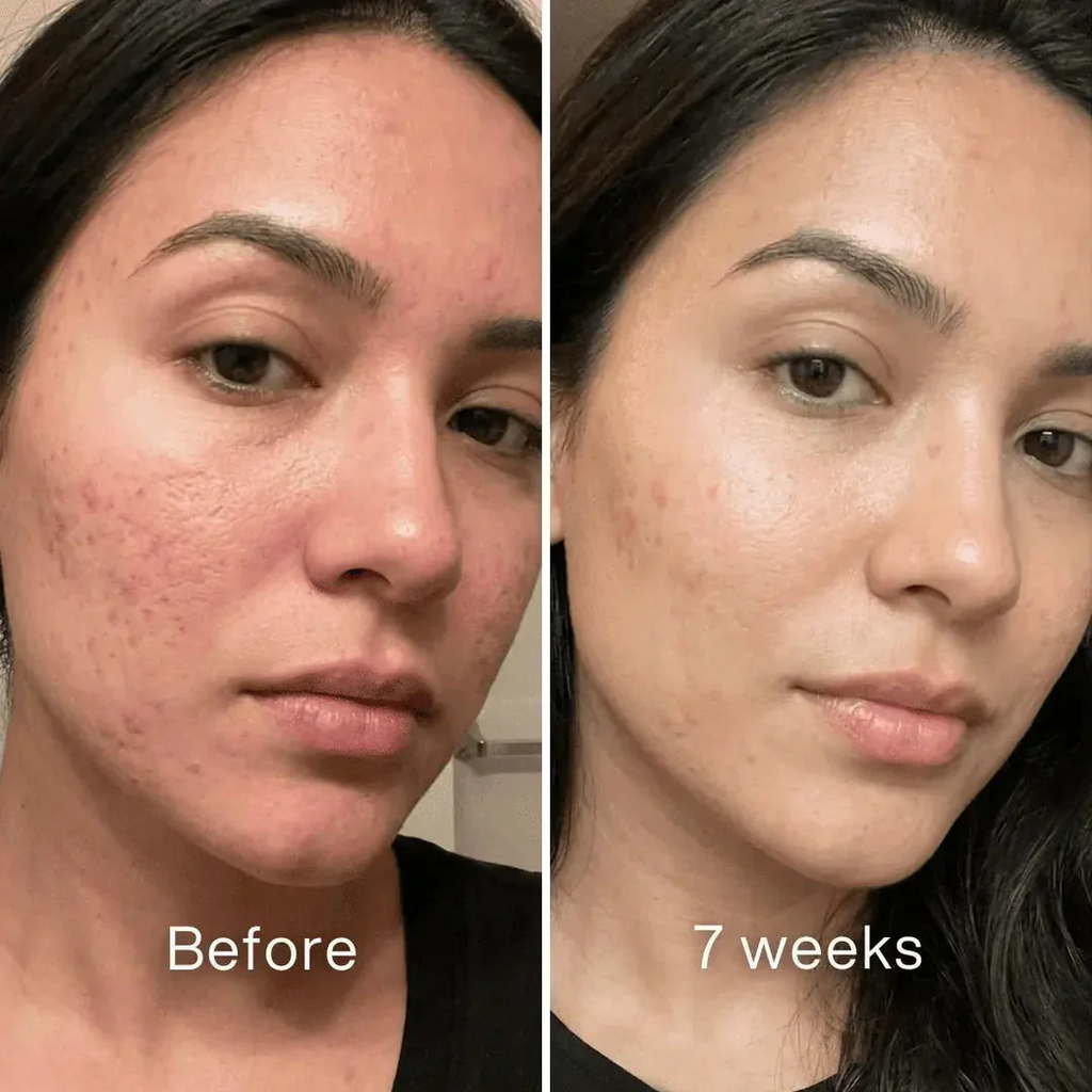 Clinical Acne Scar Repair Stick™.