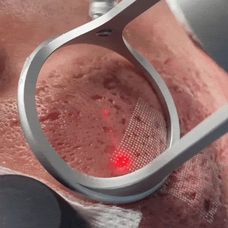 Laser treatment being applied to acne scars